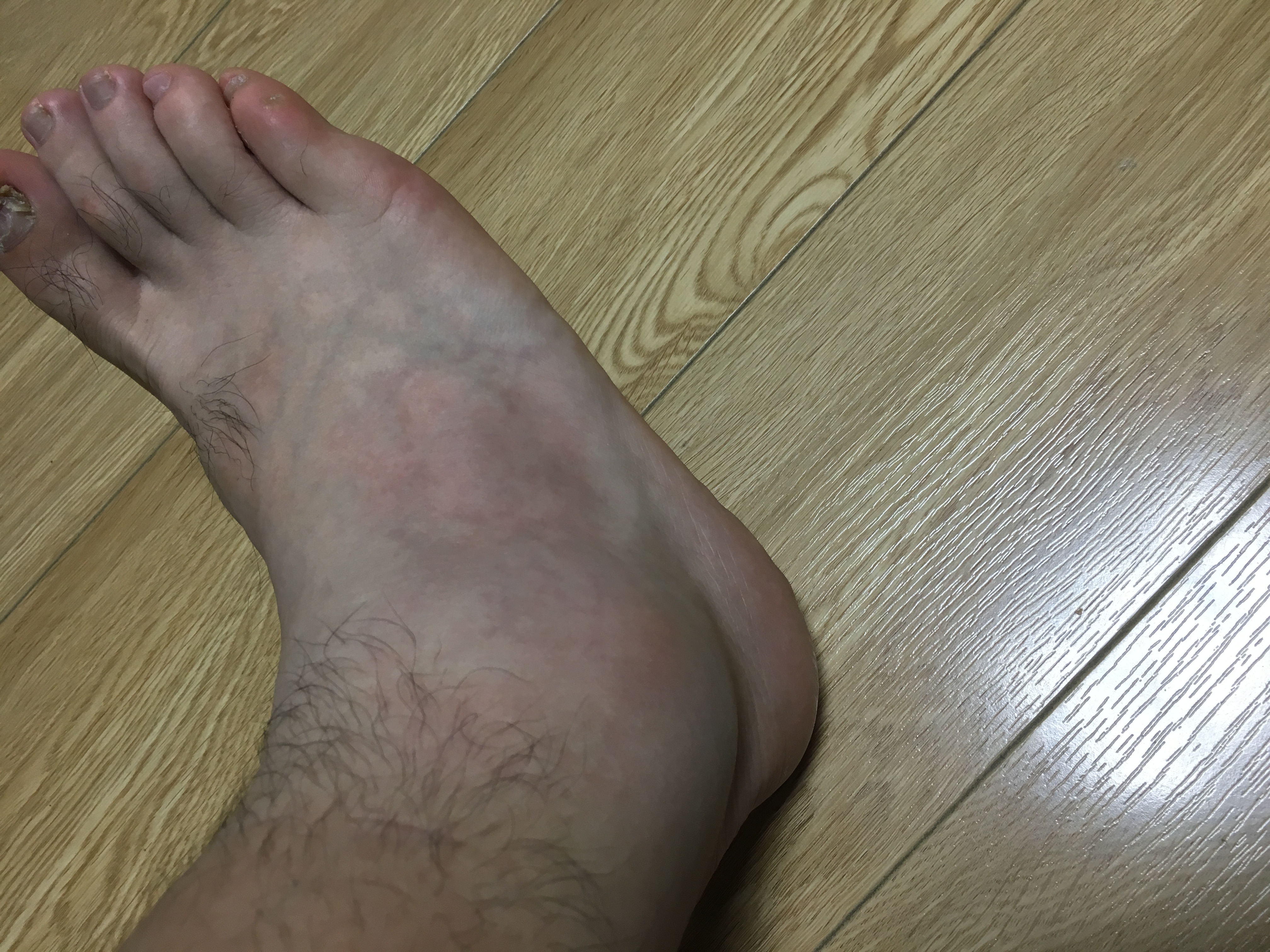 打球崴脚两天了 这么多瘀血有事吗