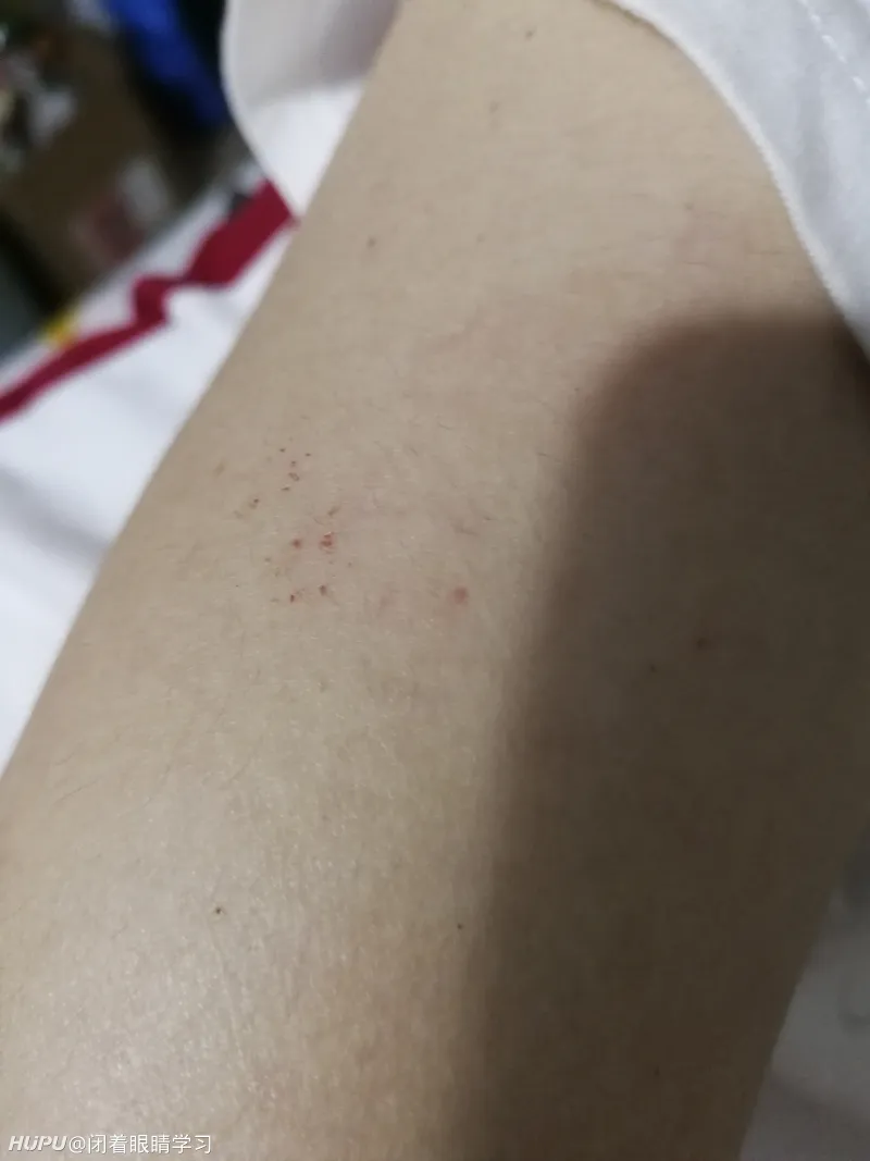 女朋友从小到大一直贫血 今天胳膊上有小红点 第5页 健身和运动健康 虎扑社区