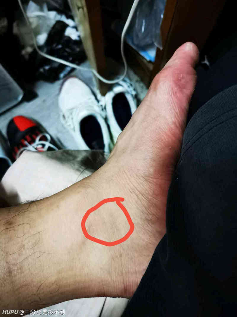 脚踝痛是怎么回事 虎扑