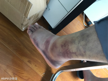 不是 应该是鞋子崴了 跟我上次崴脚一个症状