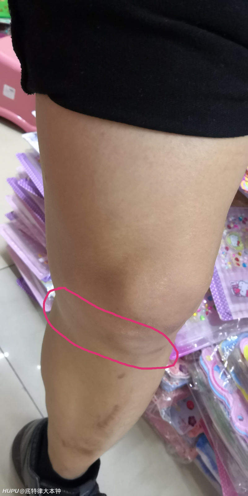 老哥们,我这是不是膝盖积液啊?