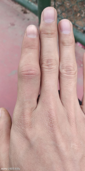 打球被球戳到手怎么办啊 第一次这么严重