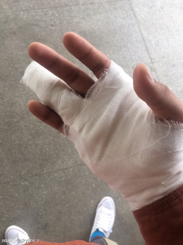 大夫没让我带护指,直接打了石膏.