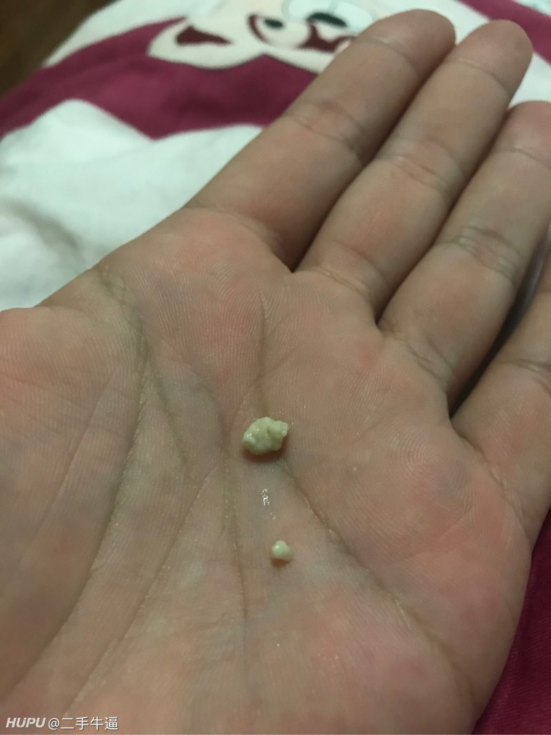 不定时 七天能有五天咳出来这个东西 有时大有时小 而且有一股臭味 软