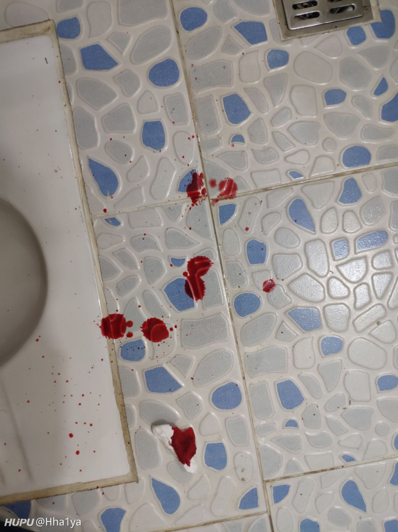 拉用力过猛流鼻血严重吗?