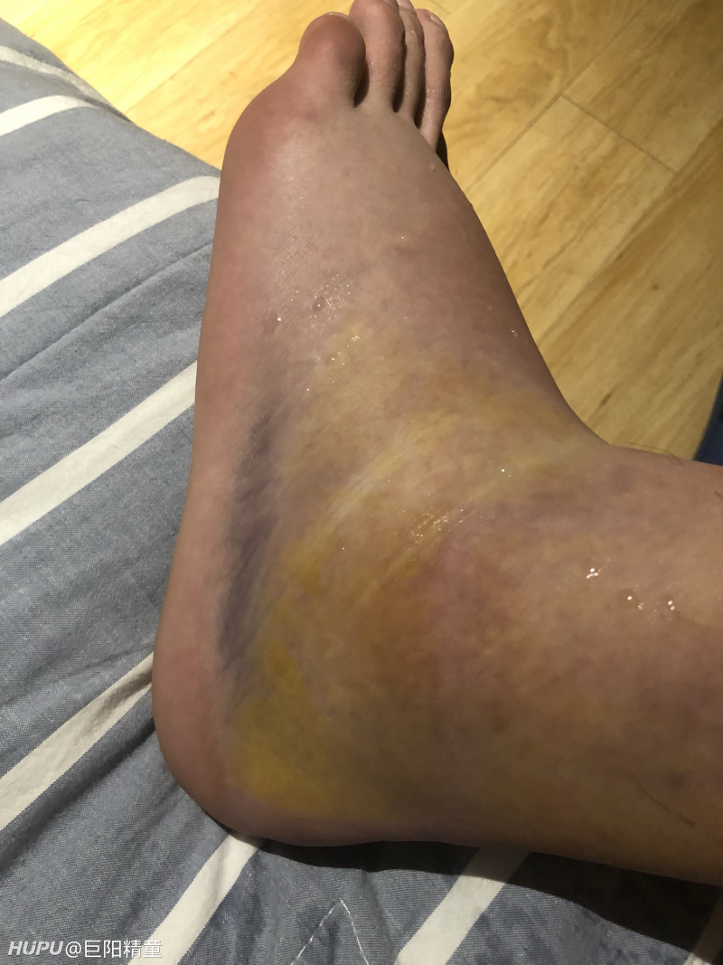 打球被人垫脚这种情况你们会让那人赔偿吗jrs们进来安慰下我