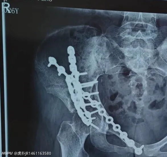 朋友髌腱断裂 求家人给意见 步行街主干道 虎扑社区 朋友髌腱断裂 求家人给意见 步行街主干道 虎扑社区