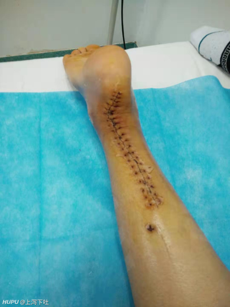 跟腱断裂,6周后拆石膏(图略重口,慎入)