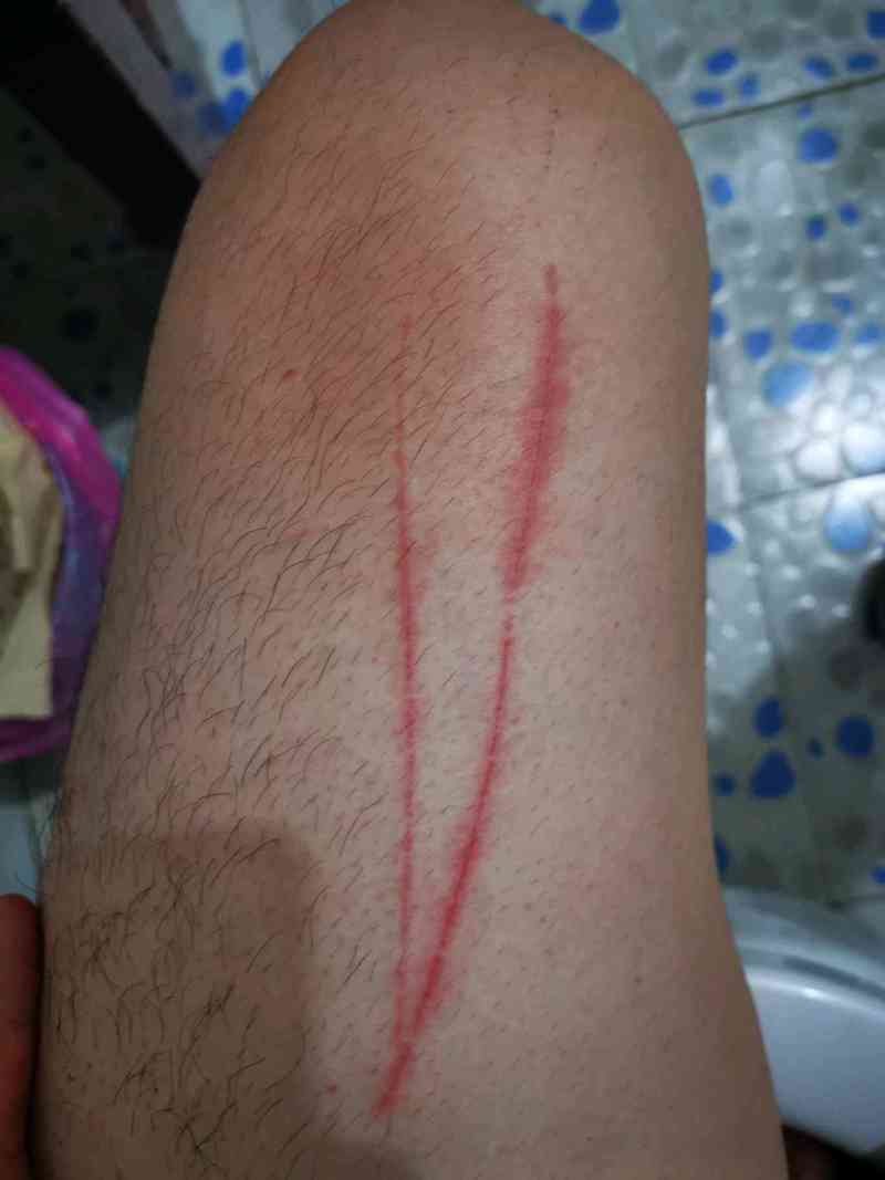 身上为什么莫名其妙出现伤痕?(图口味稍重)
