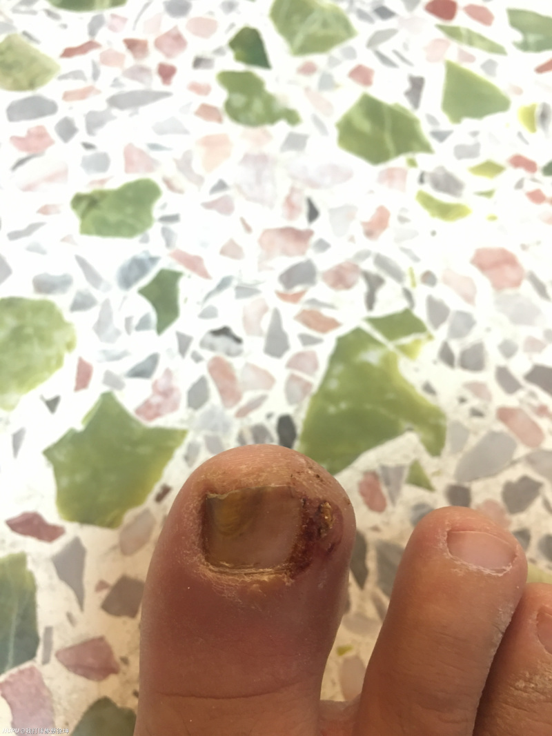 有没有甲沟炎医疗成功的老哥帮帮我 虎扑