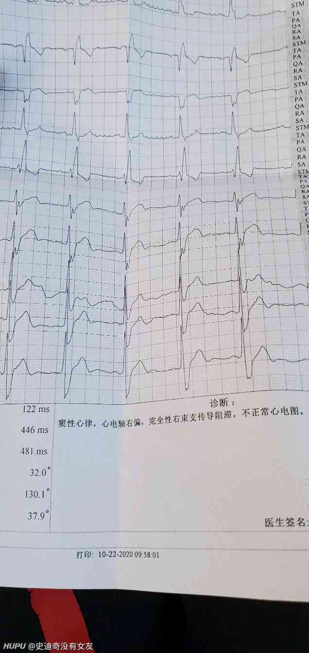心电图右束支传导阻滞 公务员体检能不能过 有经验的jr来说说 虎扑 心电图右束支传导阻滞 公务员体检能不能过 有经验的jr来说说 虎扑