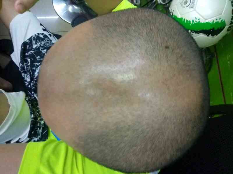 头顶有痣,是不是好的?