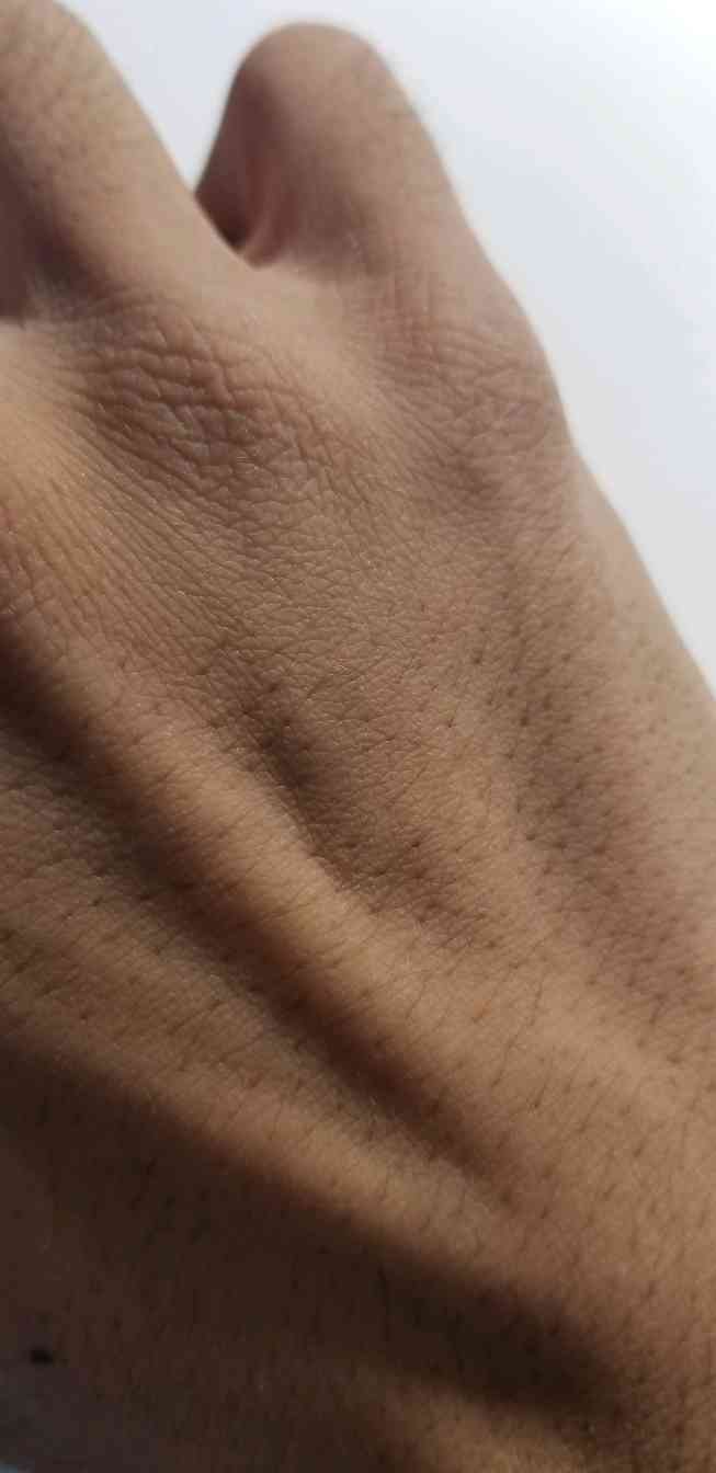 急求啊,各位jrs有手背血管蠕动的现象吗?