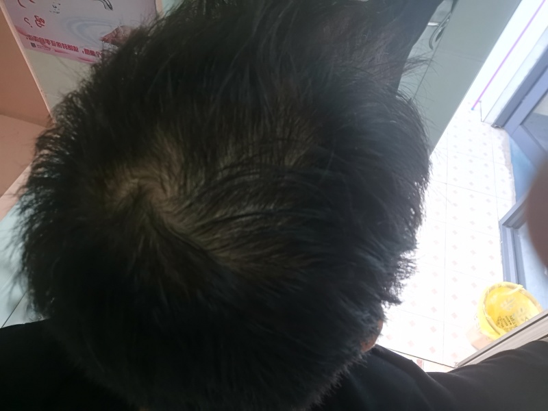脱发.真心求助.