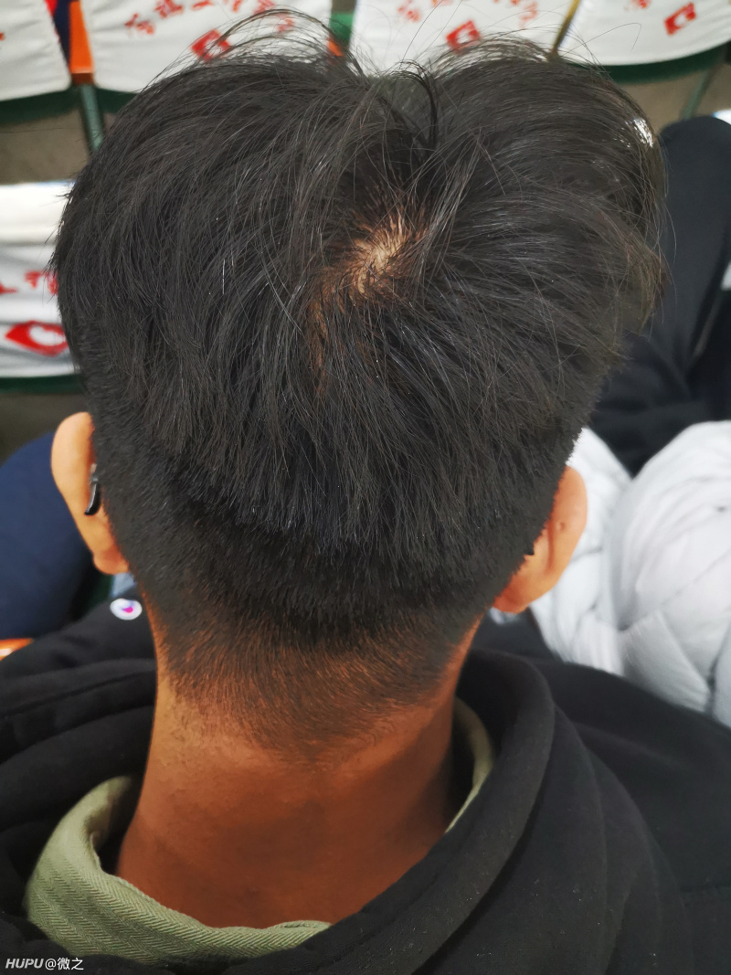 小弟今年才19岁,烫了次头发以后一直掉头发.然后发现头顶发量稀疏