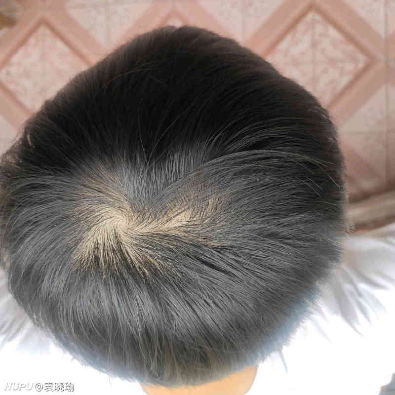 老哥们头顶旋头发稀疏正常吗 虎扑