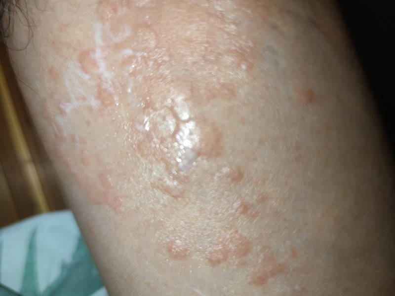 手臂腋下长小红点 老哥们看看是什么症状 有点痒 大腿内侧也有 求助 虎扑