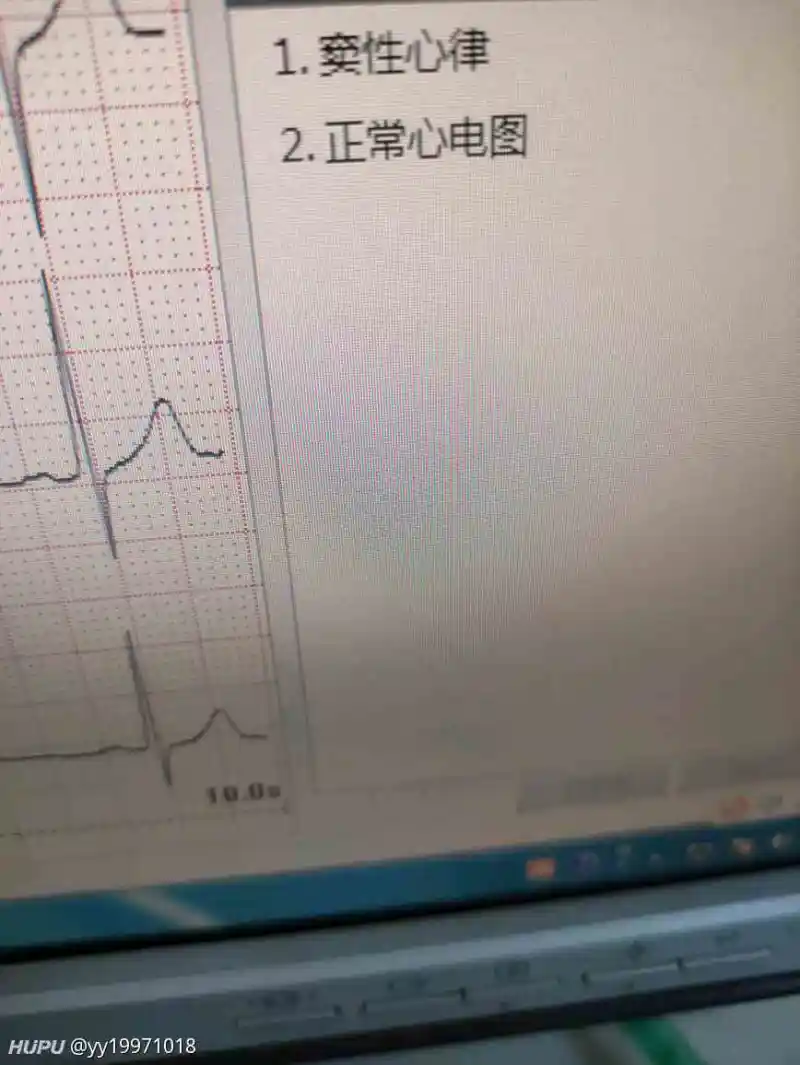窦性心律到底是不是问题？