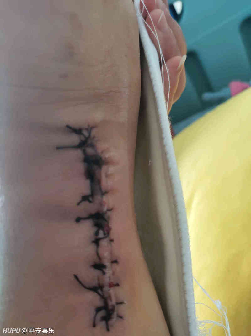 跟腱断裂术后不愈合 略血腥 虎扑 跟腱断裂术后不愈合 略血腥 虎扑