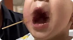 家长回应男孩玩竹签致脸部扎穿：希望大家引以为戒